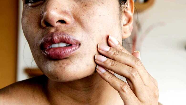 Endometriosis Acne: What is it and How to Keep it Under Control