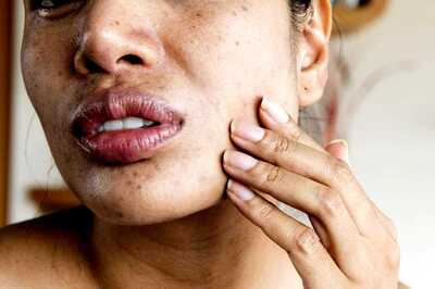 Endometriosis Acne: What is it and How to Keep it Under Control