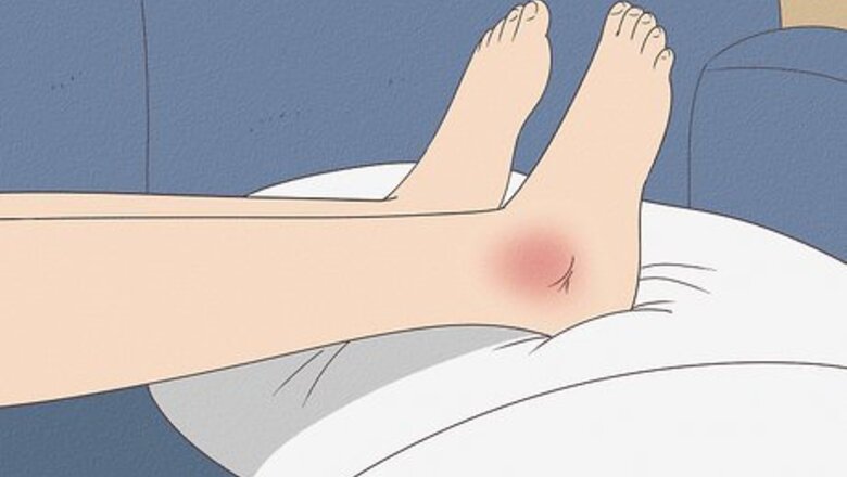 How to Reduce Swelling for Minor Injuries