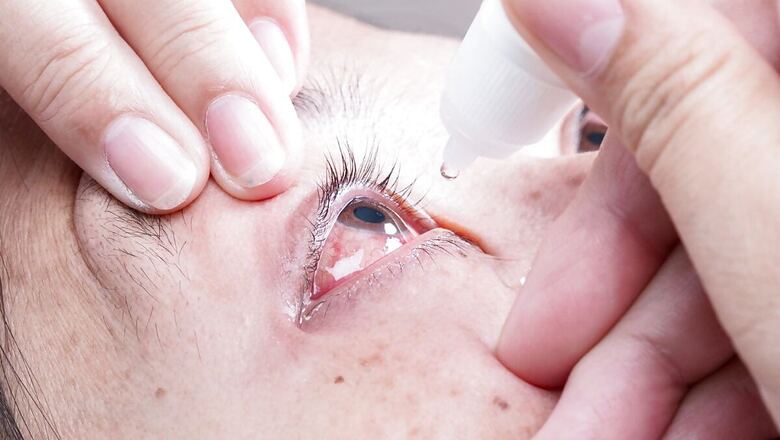What Happens If You Use An Eye Drop A Month After Opening It