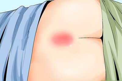 How to Treat a Pilonidal Cyst