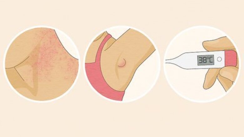 How to Treat Heat Rash