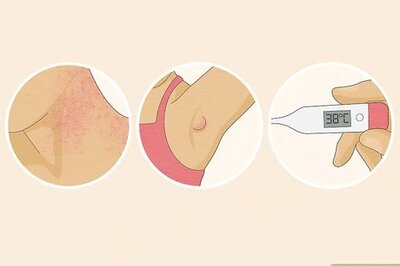 How to Treat Heat Rash