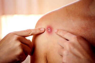 What is the Rare Monkeypox Disease? Know Cause, Symptoms and Treatment