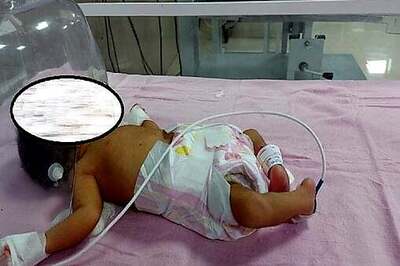 In Madhya Pradesh, Parents Abandon Rare Baby Born With Inverted Legs