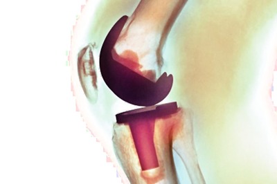 Lap-Band Surgery May Lower Chronic Knee Pain