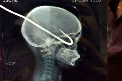 Hyderabad Doctors Remove Iron Rod From Boy's Eyeball, Skull