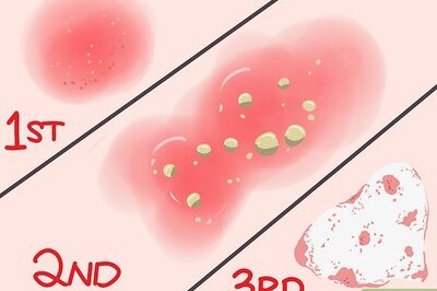 How to Treat a Burn from an Oven