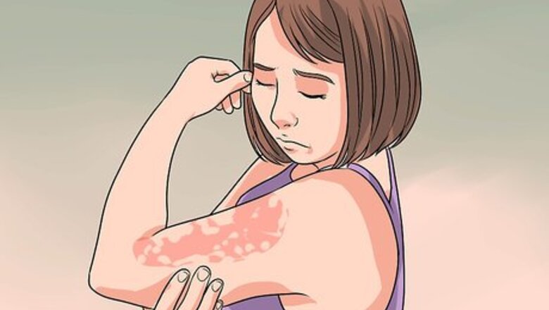 How to Decrease Eczema Flare Ups