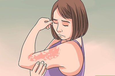 How to Decrease Eczema Flare Ups