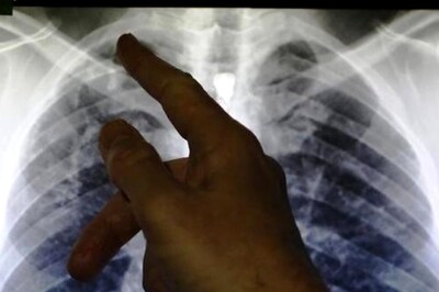 Kerala Doctors Save 2-year-old Kid Who Swallowed TV Remote Battery