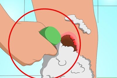 How to Quickly Heal Acne Scabs