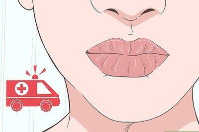 How to Heal a Lip Burn