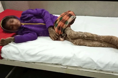 In a Remote Bastar Village, Eight-year-old Girl Battles Rare Condition That's Turning Her Skin Tree-like