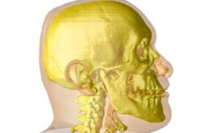 Facial transplant patient doing fine