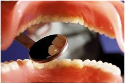 Oral Cancer: Early Signs, Symptoms and Preventive Measures