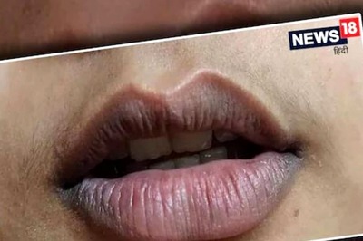 What you Should do to Get Rid of Chapped and Dark Lips