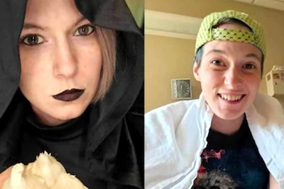 32-year-old US Woman Battling Rare Disease Connects Her Condition To Vampire