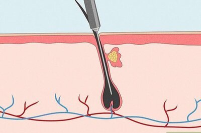 How to Remove Unwanted Hair Permanently