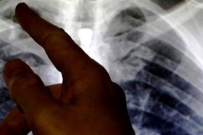Mumbai Patient Suffering from Drug-resistant TB First in Country to Get New Treatment
