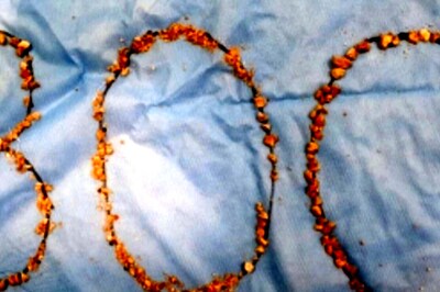 300 Kidney Stones Removed from 75-year-old Farmer at Hyderabad