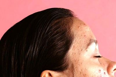 Bye, Hormonal Acne! 8 Ways To Stop Period Breakout