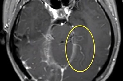 Here's Why and How You Need to Deworm as an Adult