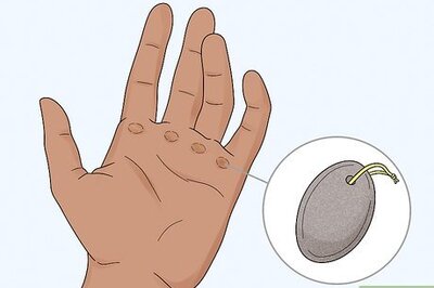 3 Simple Ways to Heal Hands from Climbing