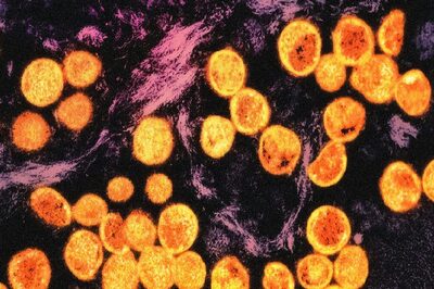 Gurugram Health Department Issues Mpox Alert, Health Officials Urge Caution; No Cases Reported Yet