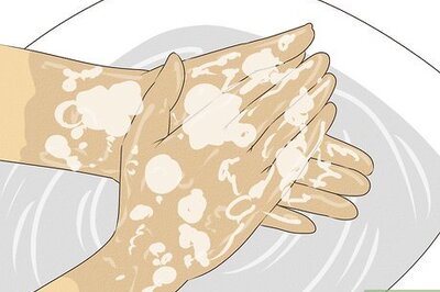 How to Treat Cracked and Callused Hands