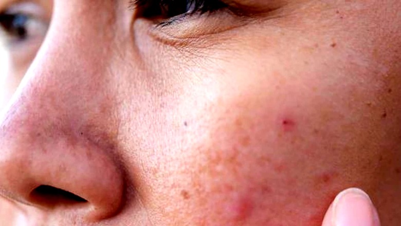 Dark Spots? Try These Home Remedies to Get Flawless Skin