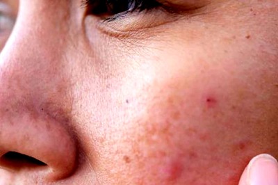 Dark Spots? Try These Home Remedies to Get Flawless Skin