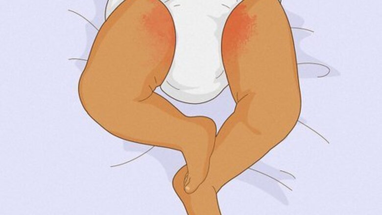 How to Relieve Diaper Rash Fast