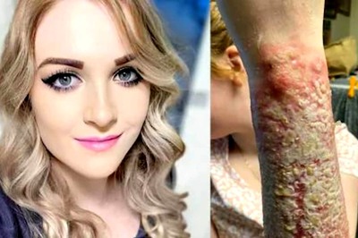 Australian Woman Bitten By Redback Spider In 2014 Is Still Being Treated; Here's Why