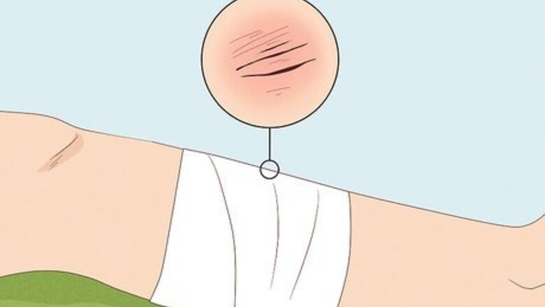 How to Apply Splints