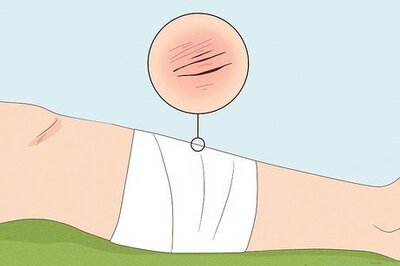 How to Apply Splints