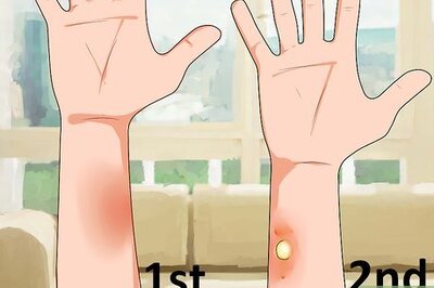 How to Stop the Burning in First Degree Burns Temporarily