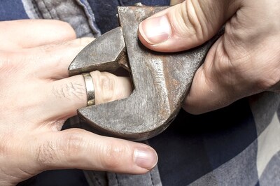 Woman Gets Rings Stuck on Her Finger Removed After 15 Years