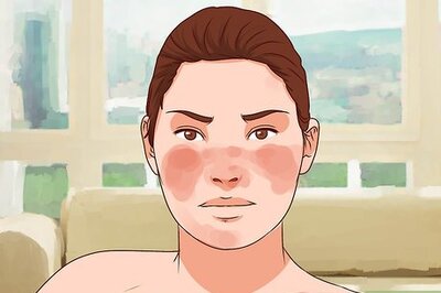 How to Diagnose Lupus