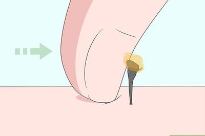 How to Treat Bee Sting Swelling