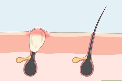 How to Treat Adult Acne